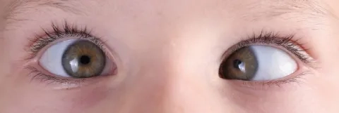 strabismus